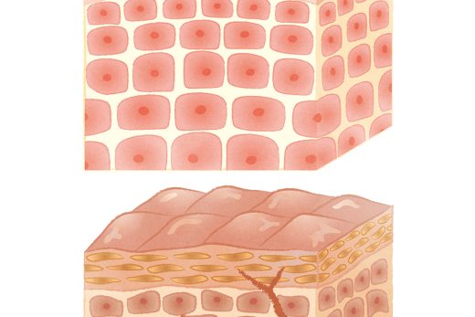 正常な肌と乾燥した肌の断面図。