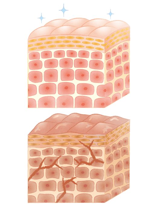 正常な肌と乾燥した肌の断面図。