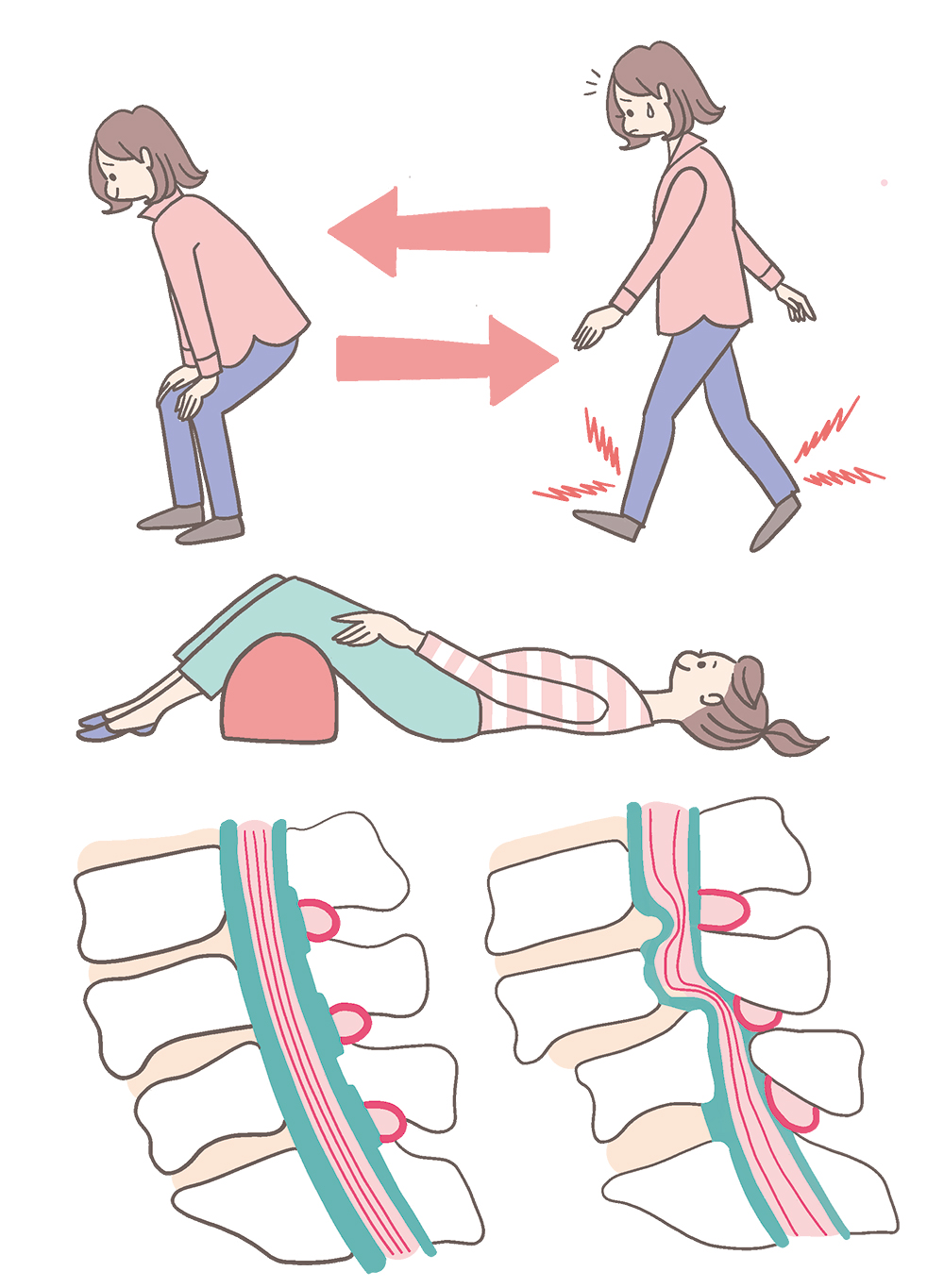 腰部脊柱管狭窄症に悩む女性のイラスト