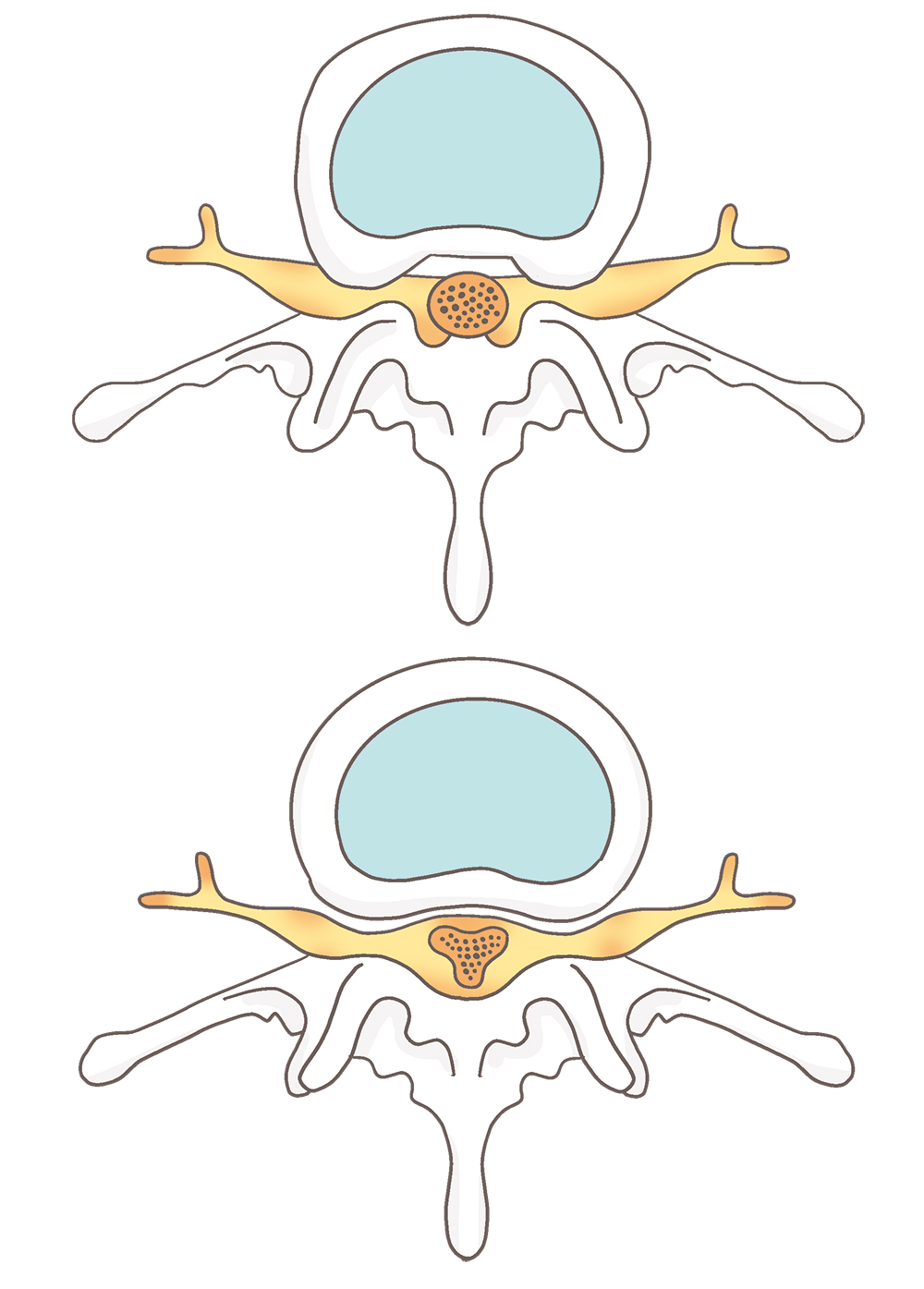 腰部脊柱管狭窄症の状態を説明するイラスト