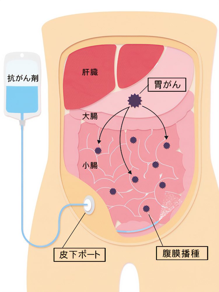 抗がん剤治療の腹膜播種に対する治療法を説明する医療イラスト