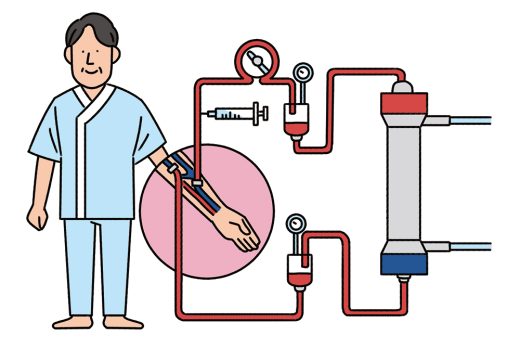 透析治療を受ける患者と装置のイラスト