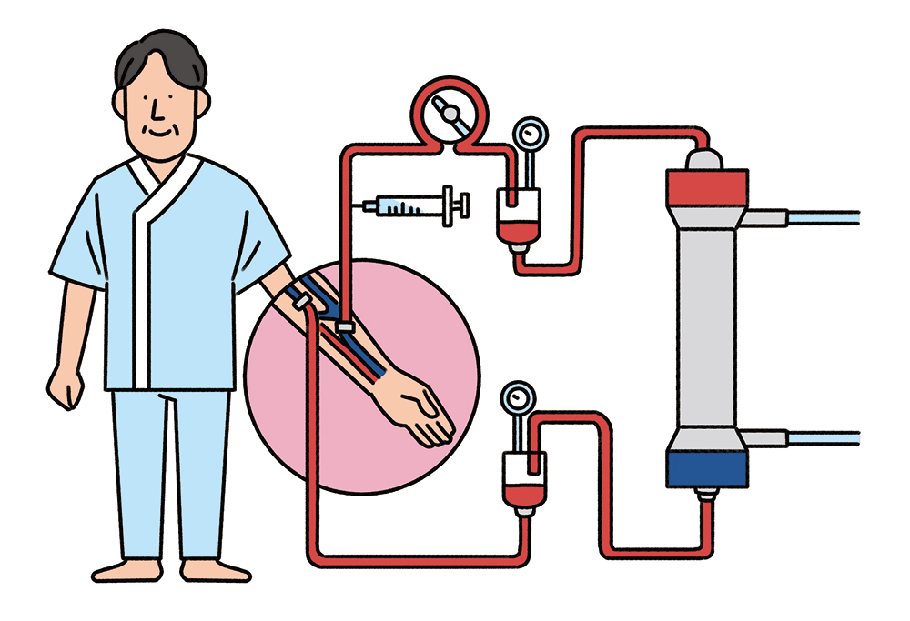 透析治療を受ける患者と装置のイラスト