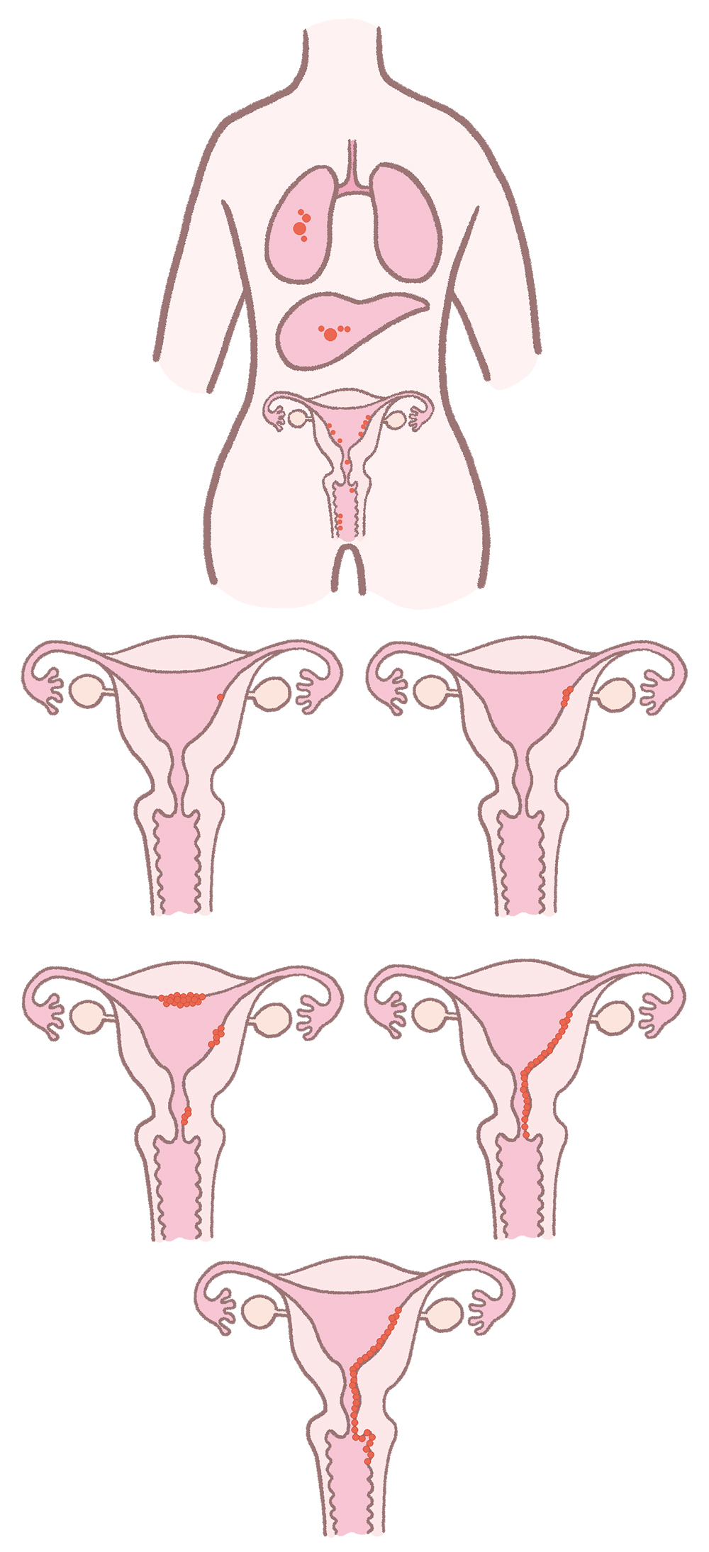子宮内膜症の進行を示す子宮と臓器のイラスト