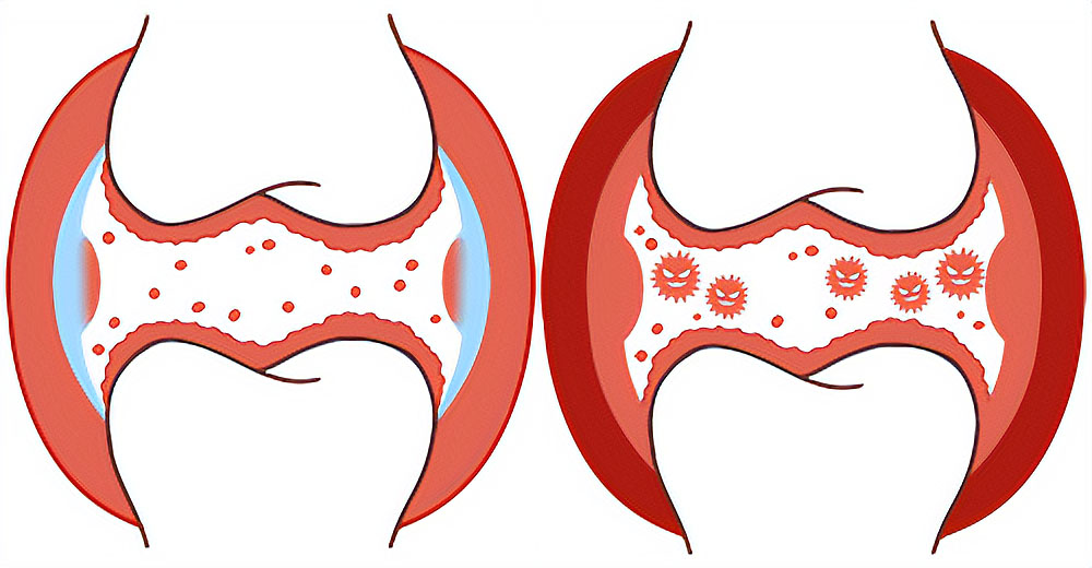 健康な関節と関節炎の比較断面図イラスト
