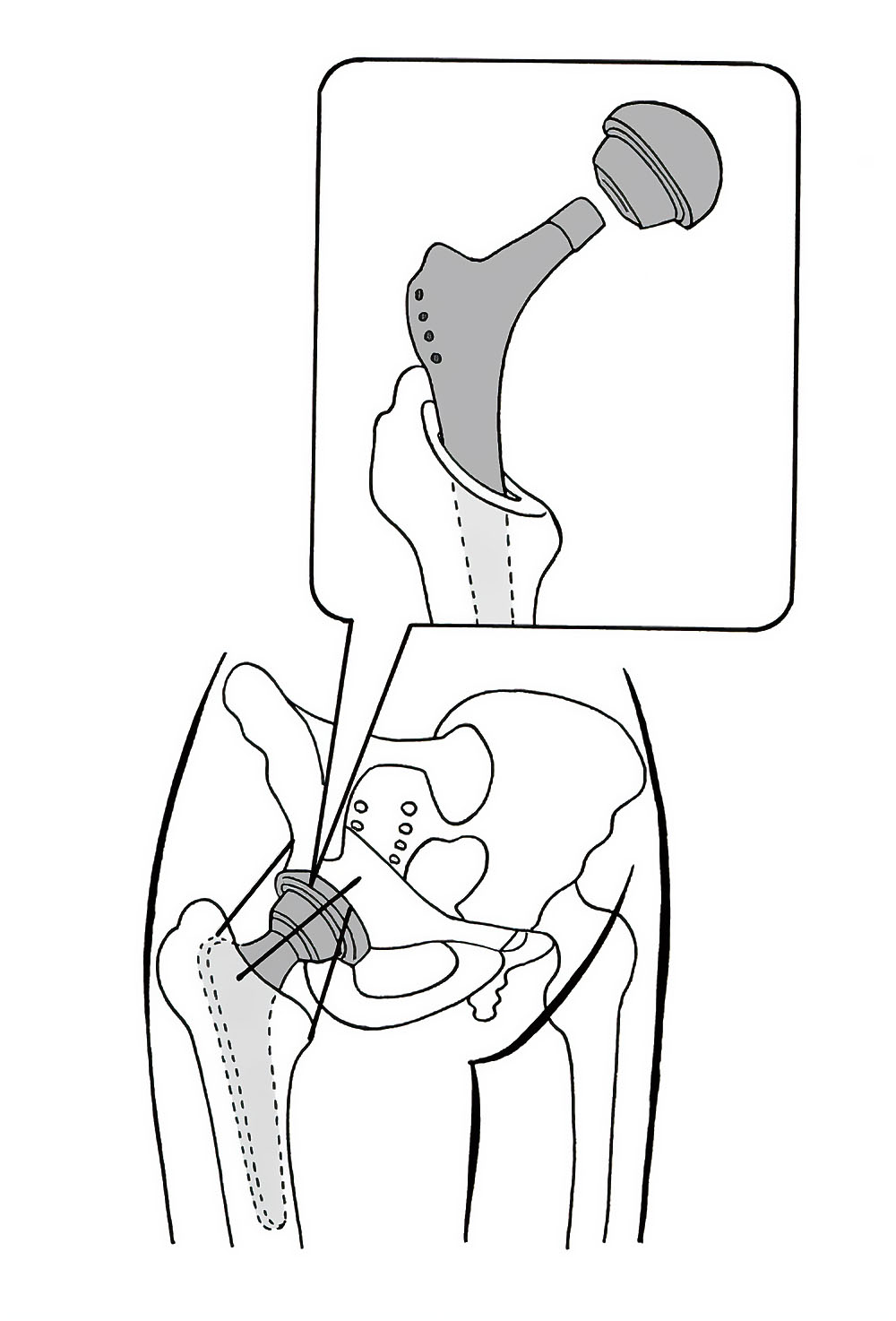 股関節置換術を示す医療用図解イラスト
