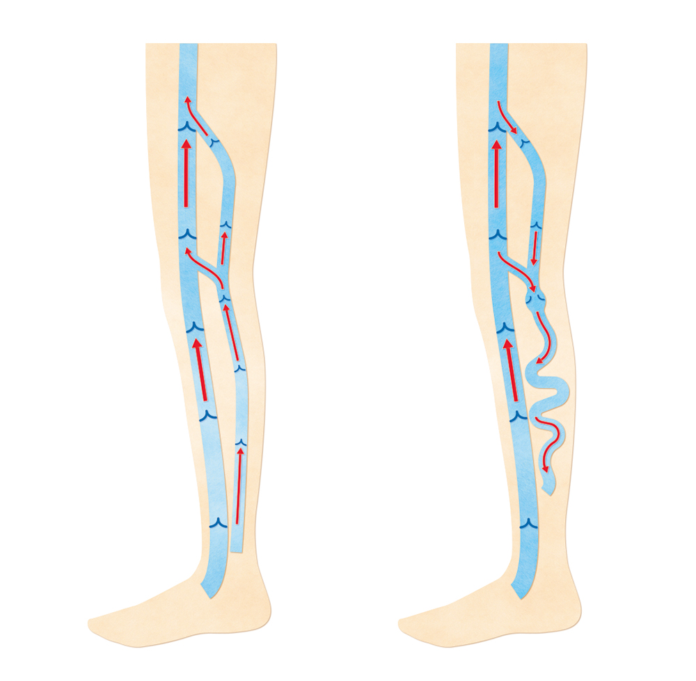 正常な静脈と静脈瘤のある脚の比較イラスト