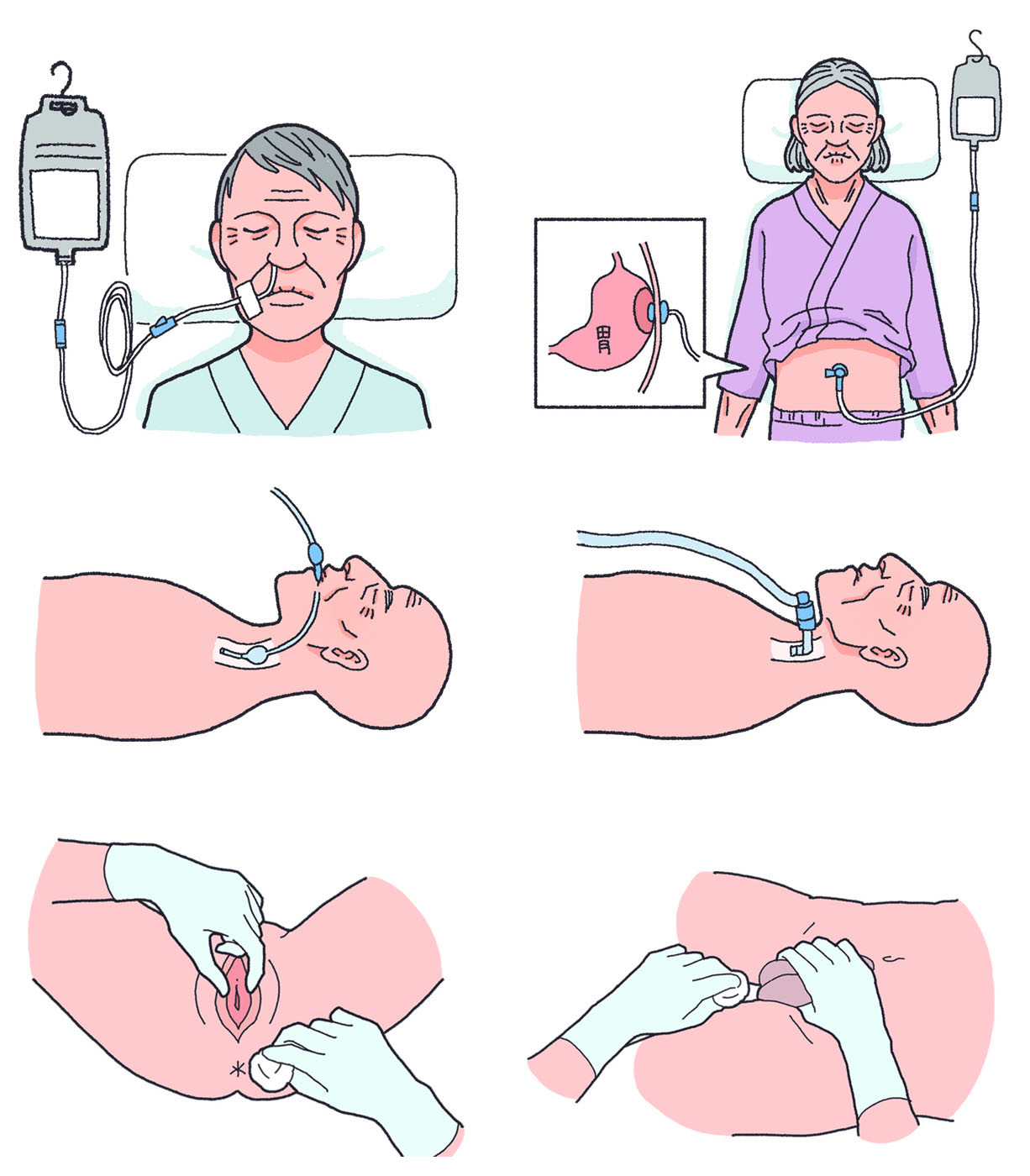 経鼻栄養チューブや胃瘻、気管切開チューブの管理のイラスト