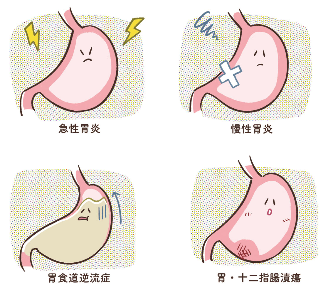 急性胃炎、慢性胃炎、胃食道逆流症、胃潰瘍を示す胃のイラスト